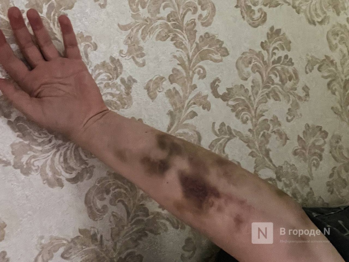 Нижегородка рассказала о жизни со сломанными из-за самоката руками
