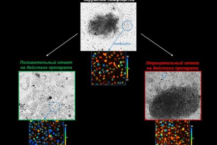 Ученые ПИМУ создали систему для контроля эффективности лечения опухоли мозга