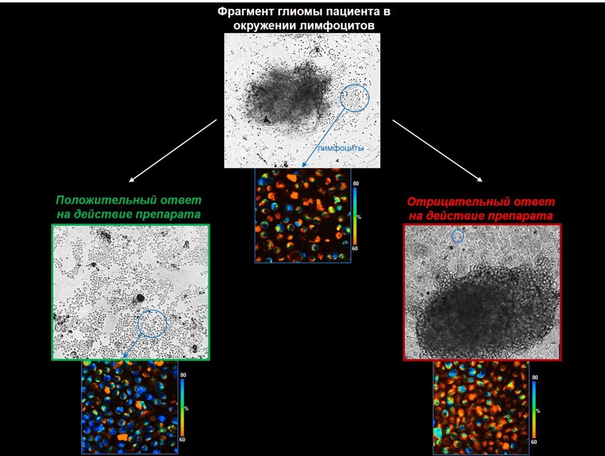 Ученые ПИМУ создали систему для контроля эффективности лечения опухоли мозга - фото 1