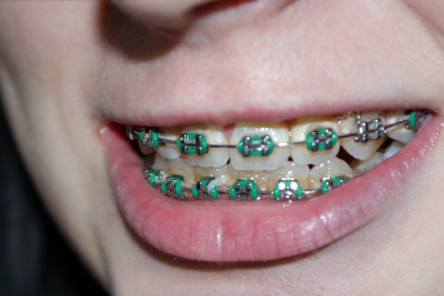 Мифы и правда о брекетах, как правильно устанавливать и ухаживать за ними